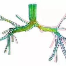 看ANSYS公司如何利用CFD助力心脏病患者手术-析模界